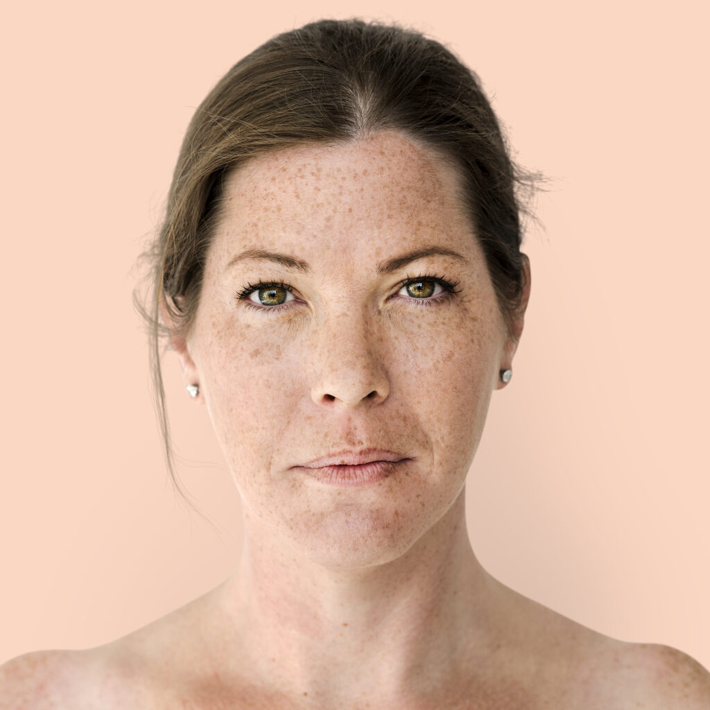 Ácido Tranexâmico para Melasma
