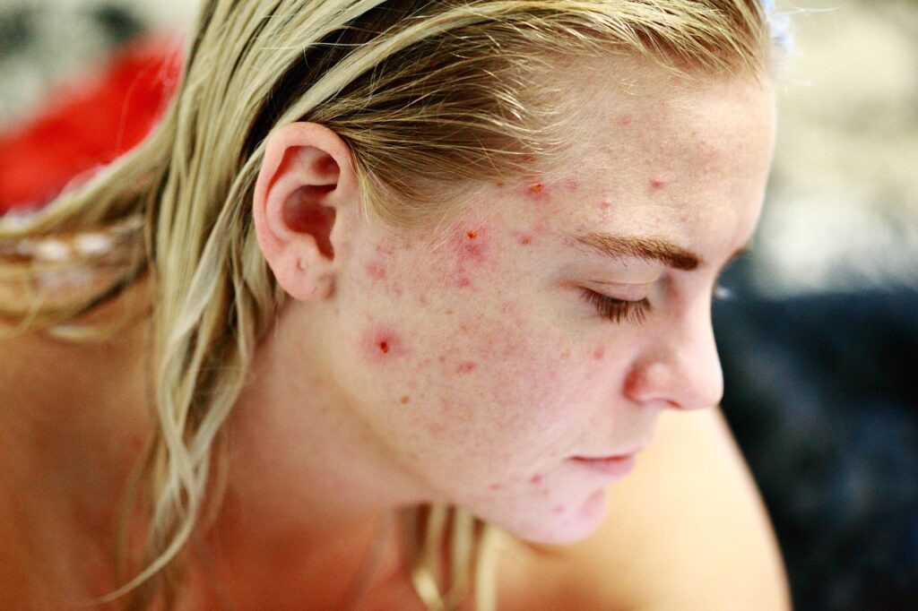 Espironolactona para Espinhas