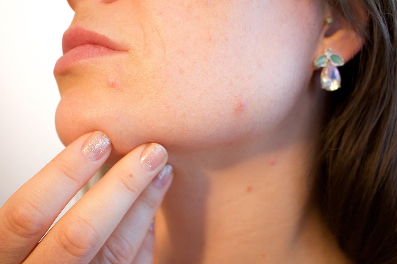 Como Tomar Espironolactona para Acne